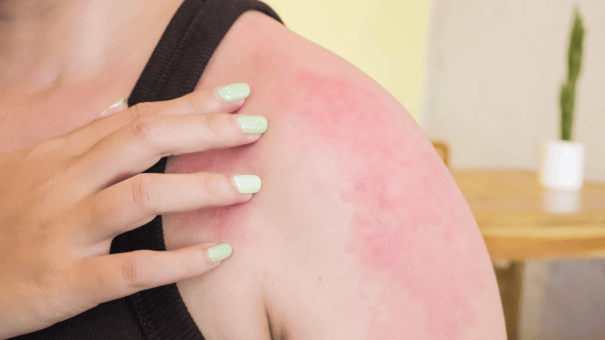 NMN vs. Niacin: Safety and Efficacy for Longevity 6 An image of a flushing matured woman.