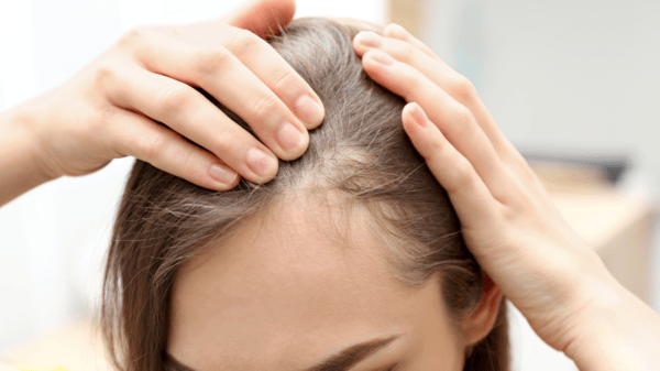 10 Creatine Myths Debunked by Science 5 An image of a woman suffering from hair loss