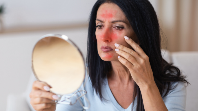 Niacin (B3): Side Effects, Reactions, Overdose Risks Explained 4 An image showing a woman with visible facial redness.