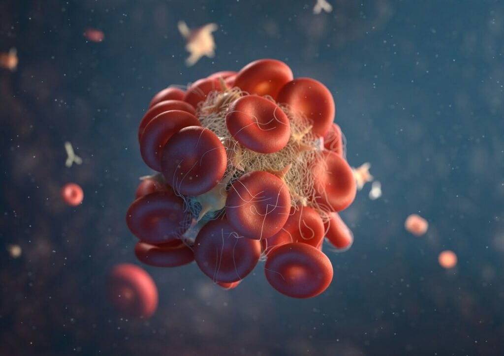 D-Dimer Test: Normal Levels and What Your Results Mean 5 A 3D image of a blood clot