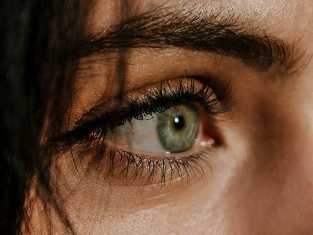 Can a Vitamin Deficiency Cause Dark Circles Under the Eyes? 6 A woman with dark circles under her eyes