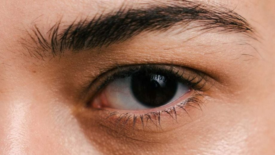 Can a Vitamin Deficiency Cause Dark Circles Under the Eyes? 1 Can a Vitamin Deficiency Cause Dark Circles Under the Eyes?