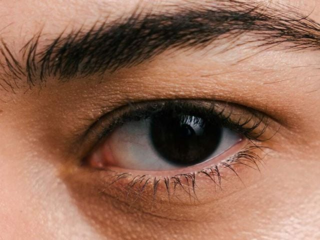 Dark circles under the eyes caused by vitamin deficiency