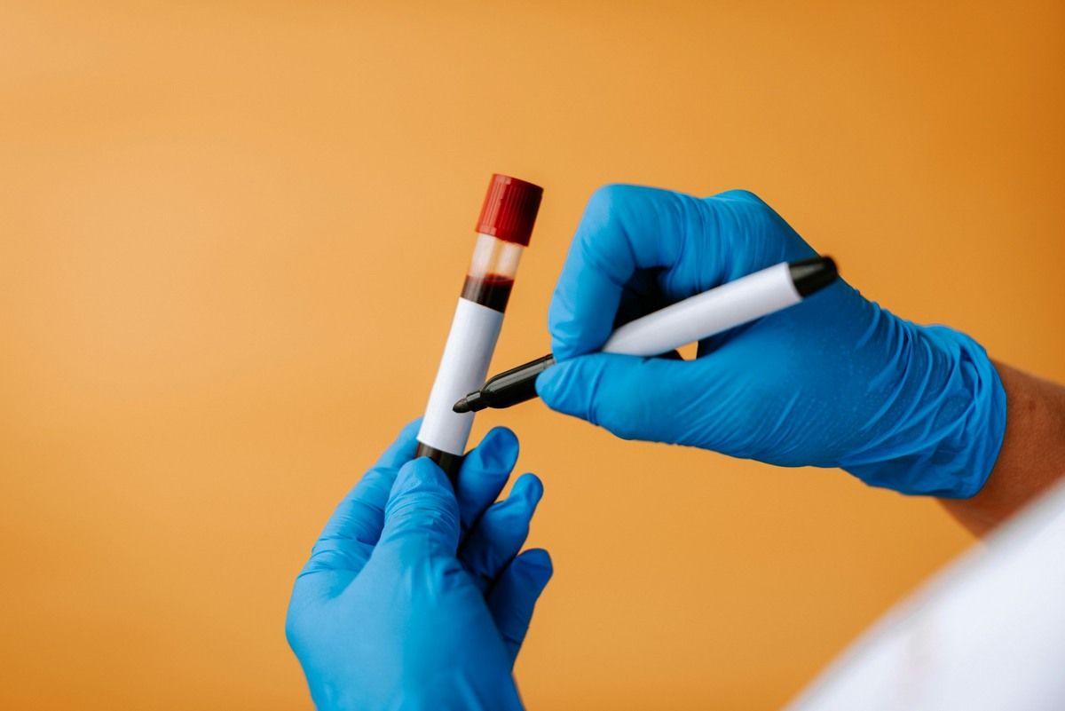 Lab technician labeling a uric acid blood test vial.