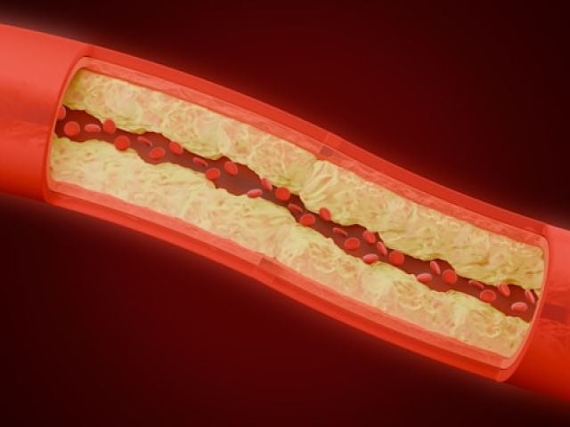 Turmeric vs Ginger: What's the Difference and Which is Best? 9 A cross-sectional view of a red blood vessel shows arterial blockage with yellow plaque buildup and dark clots inside.