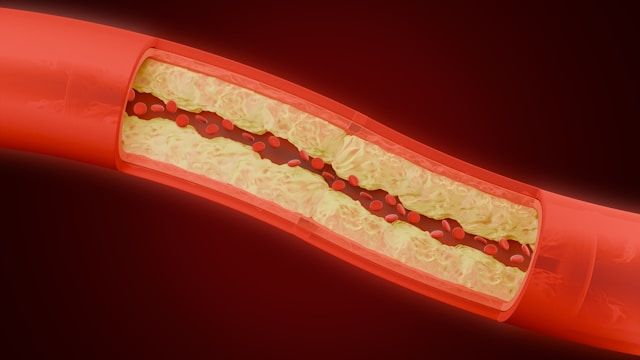 A cross-sectional view of a red blood vessel shows arterial blockage with yellow plaque buildup and dark clots inside.