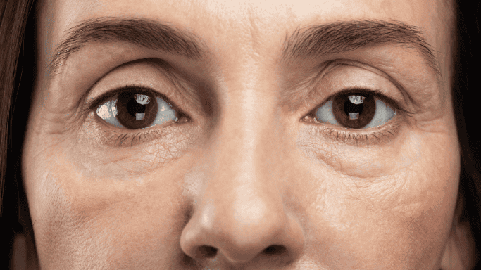 An image of a premature aging 