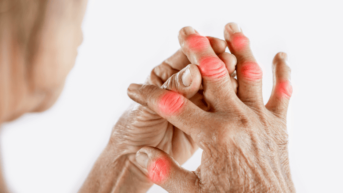 An image of a woman with joint pain