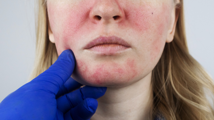 A close-up image of a woman face with red flushed skin