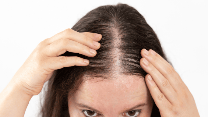 Close-up of a woman parting her hair to reveal thinning at the scalp, representing hair loss and the potential benefits of treatments for hair growth and aesthetics.